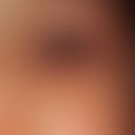 Molluscum contagiosum:&nbsp;entzündlich veränderte sehr große Molluscum-Effloreszenz. Die typisch...