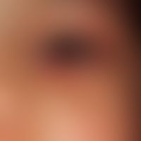 Molluscum contagiosum: regressing papule at the lower lid margin; note: in this case a conservati...