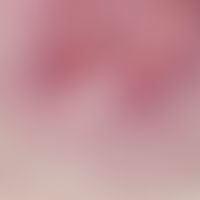 Molluscum contagiosum. detail enlargement: molluscum corpuscles arranged in a street pattern, whi...