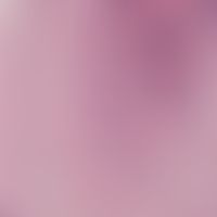 Molluscum contagiosum: molluscum corpuscles arranged in a street pattern, which start in the supr...