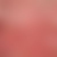 Molluscum contagiosum: General view: Strongly itchy suberythrodermia with infestation of the enti...