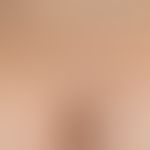 Molluscum contagiosum:&nbsp;disseminierte&nbsp; Mollusca contagiosa bei einem immunkompetenten Pa...