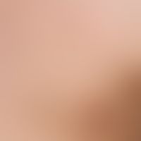 Molluscum contagiosa: multiple, 0.2-0.3 cm large, yellow-reddish, firm, shiny, completely asympto...