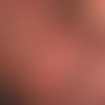 Molluscum contagiosum: seit Monaten bekannte klinische Symptomatik mit meist aggregierten&nbsp;bi...