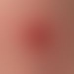 Molluscum contagiosum: spontane Abheilung mit residualer Krustenbildung.

