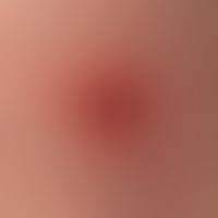 Molluscum contagiosum: spontaneous healing with residual crust formation
