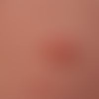 Molluscum contagiosum:typical central navel of the papules. 
