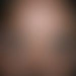 Molluscum contagiosum: ausgedehnter Befund bei bekannter HIV-Infektion.
