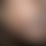 Molluscum contagiosum: ausgedehnter Befund bei bekannter HIV-Infektion.
