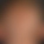 Monilethrix syndrome. 28-year-old female patient has had sparse hair growth with easily falling o...