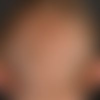 Monilethrix syndrome. 28-year-old female patient has had sparse hair growth with easily falling o...