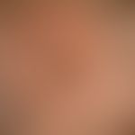 Monilethrix Syndrome. Enlargement: sparse hair growth, especially in the back of the head, someti...