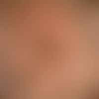 Monilethrix Syndrome. Enlargement: sparse hair growth, especially in the back of the head, someti...