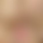 Monilethrix syndrome. detail enlargement: Rarefied hair growth and hair follicles in the area of ...