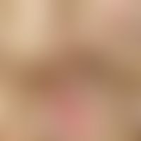 Monilethrix syndrome. detail enlargement: Rarefied hair growth and hair follicles in the area of ...