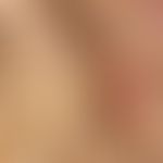 Monilethrix syndrome. detail enlargement: fragile, thin hairs with spindle formation can be seen;...