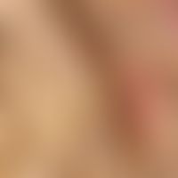 Monilethrix syndrome. detail enlargement: fragile, thin hairs with spindle formation can be seen;...