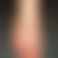 Mononukleose, infektiöse. Stärkere Konfluenz der makulösen und urtikariellen Erytheme im Bereich ...