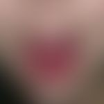 Mononucleosis, infectious. red, smooth, raspberry-coloured, coating-free tongue with few petechia...