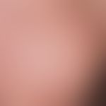 Mononucleosis, infectious. generalized, possibly itchy, urticarial, morbilliform or rubeoliform e...