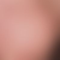 Mononukleose, infektiöse. Generalisiertes, evtl. juckendes, urtikarielles, morbilliformes oder ru...