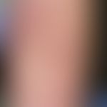 Mononucleosis, infectious: slightly itchy, urticarial, small-spotted, locally confluent haemorrha...