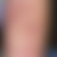 Mononukleose, infektiöse: wenig juckendes, urtikarielles, kleinfleckiges, stellenweise konfluiert...