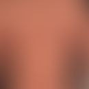 Mononuleose, infektiöse. Generalisiertes (nahezu universelles)&nbsp;makulöses Exanthem.
