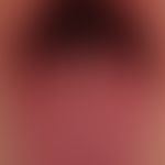 mononuleosis, infectious. generalized (almost universal) macular exanthema. raspberry tongue with...