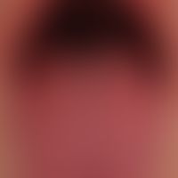 Mononuleose, infektiöse. Generalisiertes (nahezu universelles)&nbsp;makulöses Exanthem. Himbeerzu...