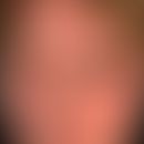 Morbihan, M.. overview: Chronic persistent swelling of the right half of the face, especially of ...