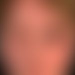 Morbihan, M.. overview: Chronic persistent swelling of the right half of the face, especially of ...