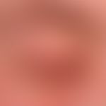 Morbihan, M. Detailed view: Chronic persistent swelling of the upper eyelid with redness of the c...