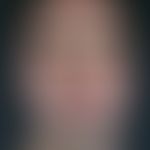 Morbihan, M.. Large red smooth spot, homogeneously affecting the whole face, chronically stationa...