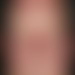 Morbihan, M.. Doughy facial swelling in the cheek and eyelid area with extensive redness of the f...