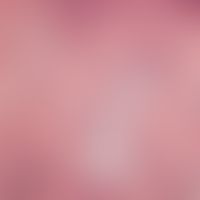 Mucinosis follicularis. Unförmig aufgetriebener Follikel mit vakuolig degenerierten Epithelien. P...