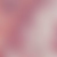 Mucinosis follicularis. Detailvergrößerung: Follikelepithel und lymphoides Infiltrat sind zu eine...