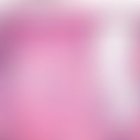 Mucinosis follicularis: komplette, vakuoläre Follikeldegeneration mit Ausbildung optisch leerer, ...