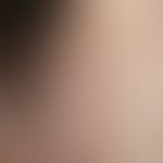 Mucinosis follicularis: juckende, disseminierte, follikuläre, gut abgegrenzte, spitzkelige, hautf...