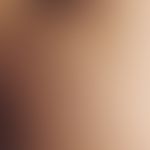 Mucinosis follicularis: akutes, nach starkem Schwitzen entstandenes Krankheitsbild. Multiple, gen...