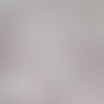 Mucor mycosis; mucor species in the skin; thin-walled, broad (3-15 µm), unseptized hyphae; GMS st...