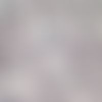 Mucor mycosis; mucor species in the skin; thin-walled, broad (3-15 µm), unseptized hyphae; GMS st...