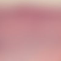 Mycosis fungoides. Detailvergrößerung: Leichte bis mäßige Akanthose, Orthokeratose, epidermotrope...