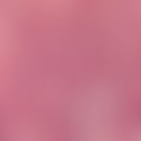 Mycosis fungoides. Detailvergrößerung: Tumorstadium. Mittelgroße Tumorzellen mit ausgeprägter, te...