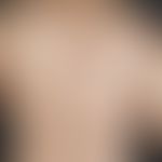 Mycosis fungoides. 59-year-old female patient with foudroyant mycosis fungoides, now tumor stage(...