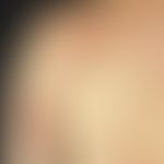 Mycosis fungoides. patch stage (early form of mycosis fungoides) Sharply limited, scaly erythema ...