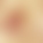 Mycosis fungoides: Detail enlargement; reddish-brown scaly erythema that has been present for man...