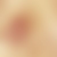 Mycosis fungoides: Detail enlargement; reddish-brown scaly erythema that has been present for man...