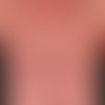 Mycosis fungoides: 52-year-old man (tumour stage of mycosis fungoides). 52-year-old man (tumour s...