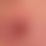 Mycosis fungoides, ulcerated lump on a reddened and scaly area on the back of a 55-year-old man w...